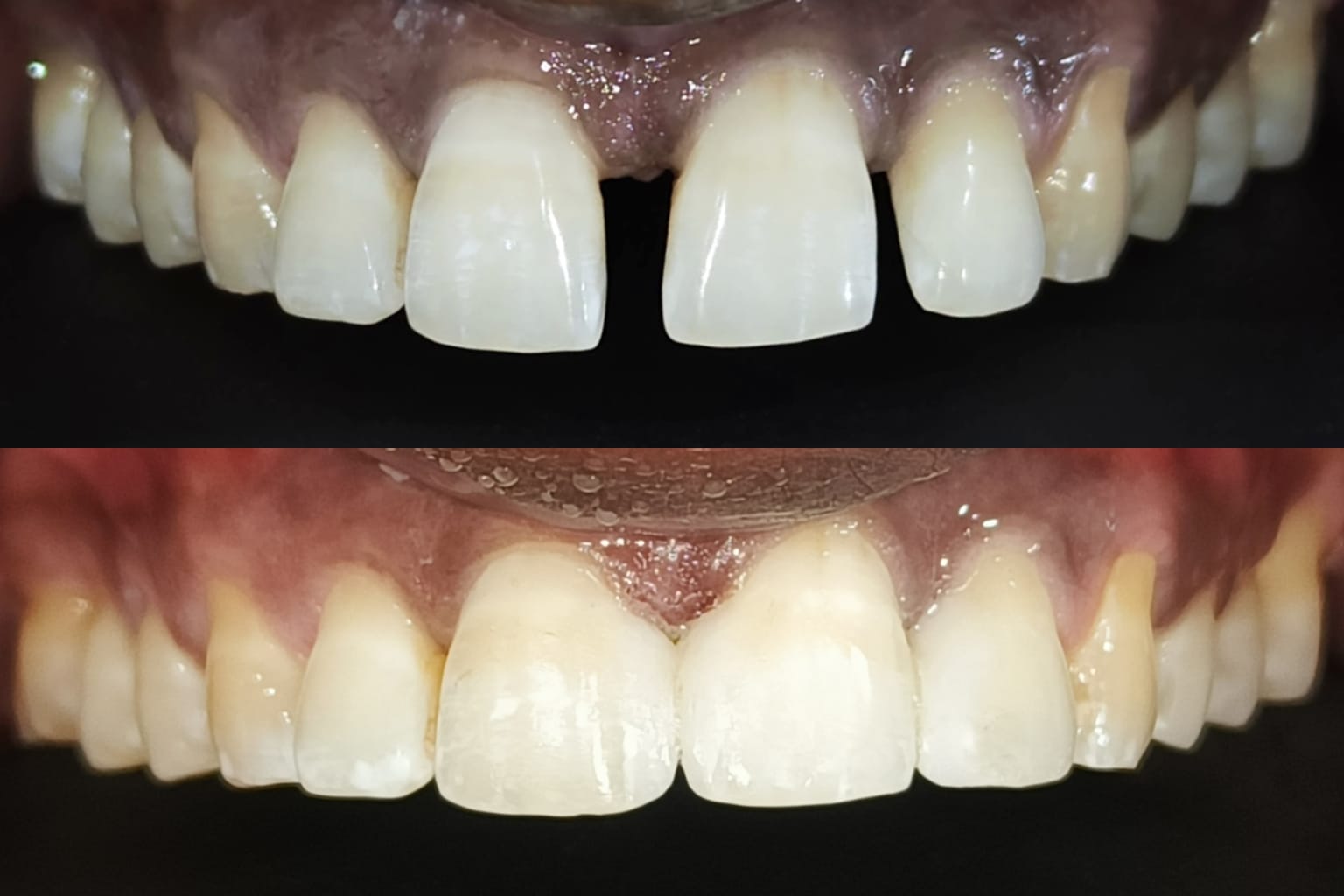 Before and after smile makeover showing gap closure treatment